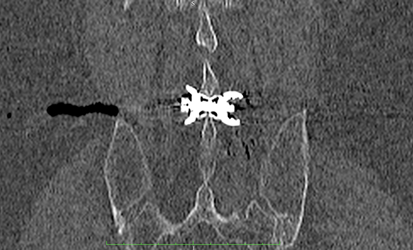 pose-implant-inter-epineux-percutane-sous-scanner