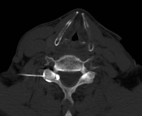 Infiltration rachidienne cervicale sous scanner