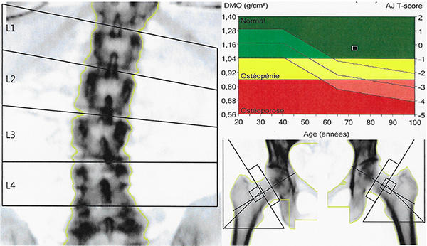 osteodensitometrie