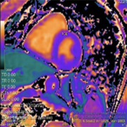 Séquence Mapping T1 petit axe