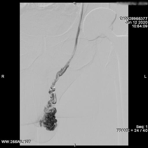 Embolisation de varicocèle